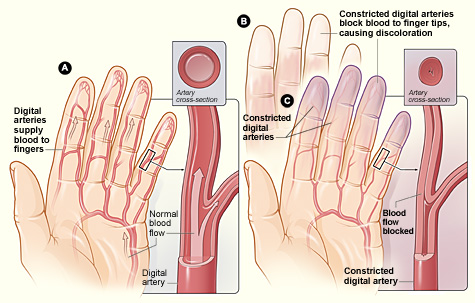 Raynaud's Syndrome Chiropractor