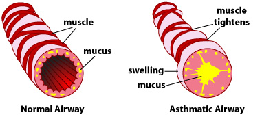 asthma-airways-mucus-chiropractic