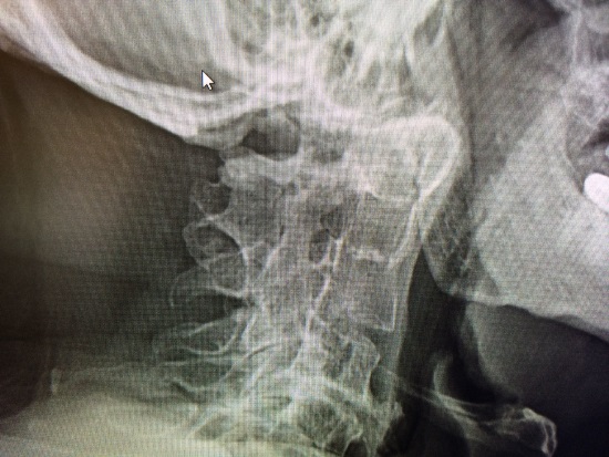 cervical spine malformation lateral x ray