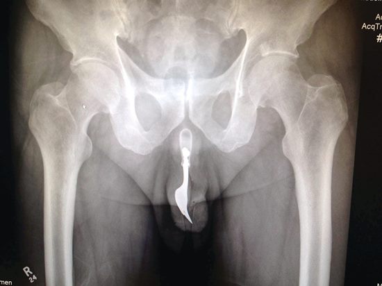 fork penis x ray