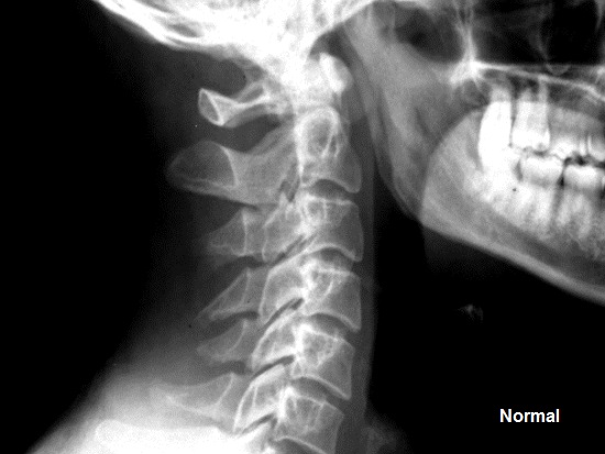 normal cervical lateral x ray